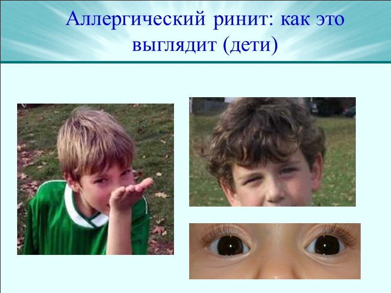 Аллергический ринит: как это выглядит (дети)